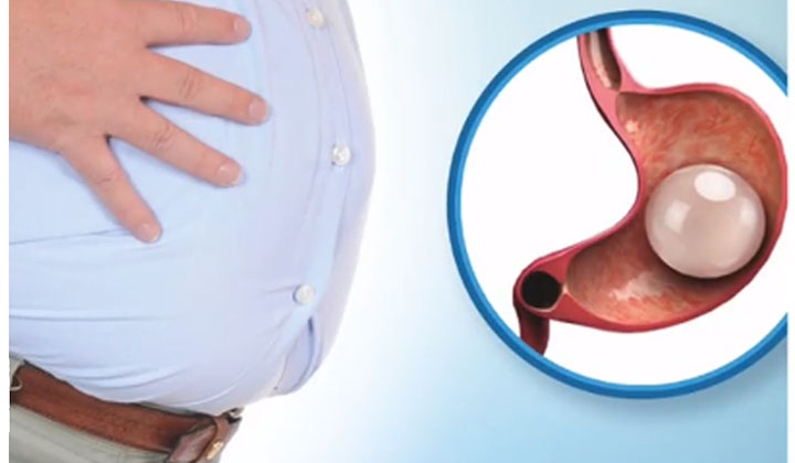 Fazla kilolar mide balonuyla uçup gidiyor