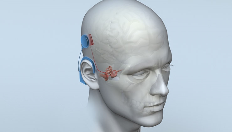 Biyonik kulak ameliyatında yaş sınırı var mı?